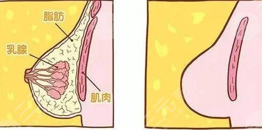 隆胸