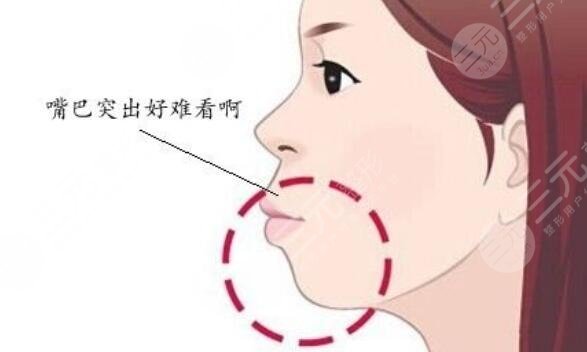 下巴后縮