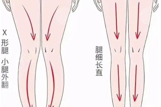 腿型矯正