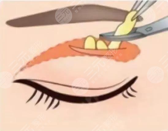 雙眼皮