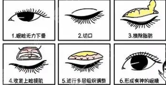 雙眼皮
