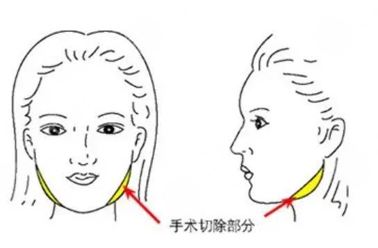 磨骨