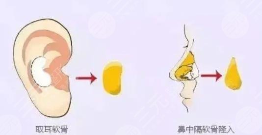 隆鼻