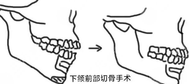 正頜手術