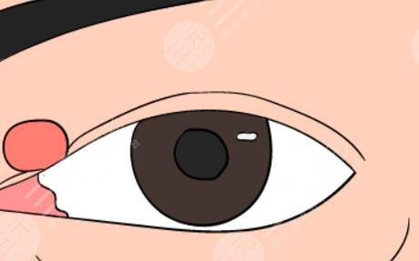 內(nèi)眼角