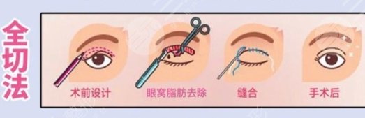 雙眼皮