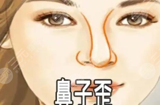 歪鼻矯正