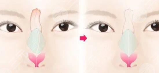 歪鼻矯正