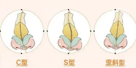 歪鼻矯正