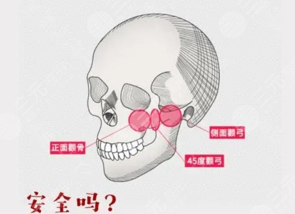 顴骨