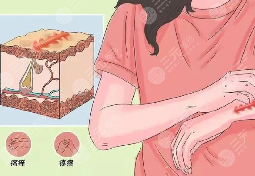祛疤