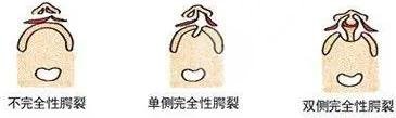 唇裂