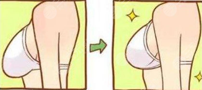 乳房懸垂