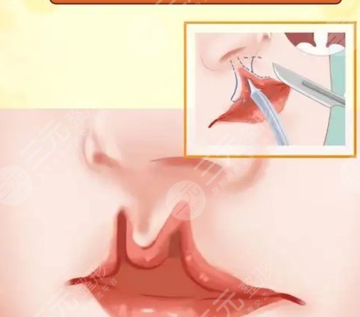 唇腭裂