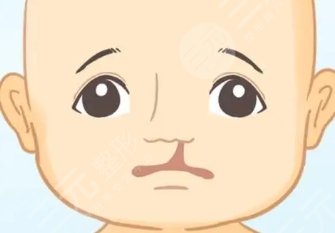 唇腭裂