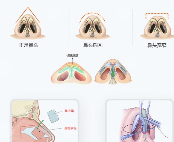 鼻綜合
