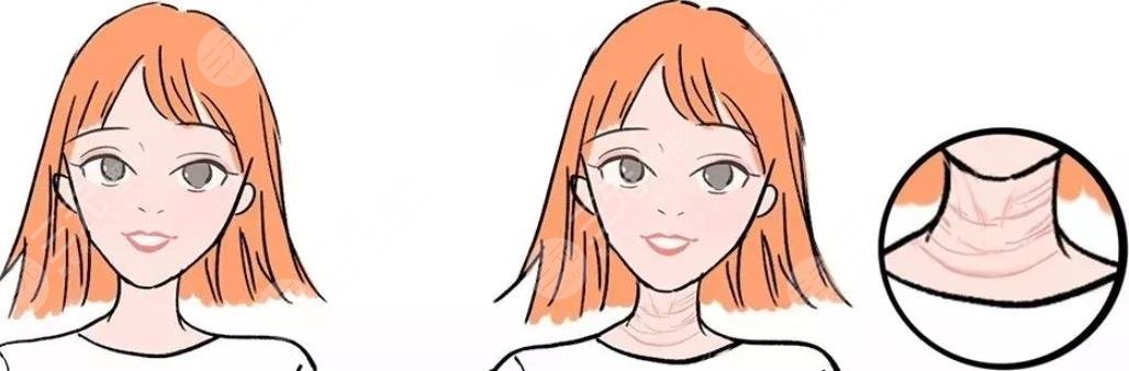 頸紋