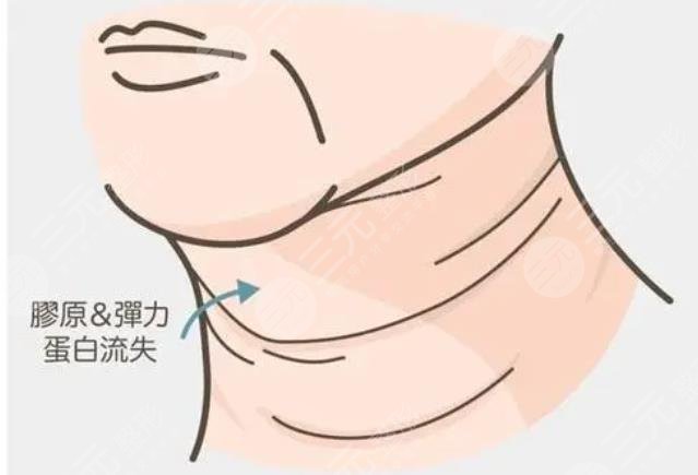 頸紋