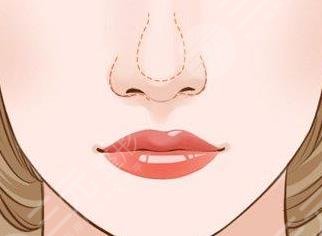 鼻小柱
