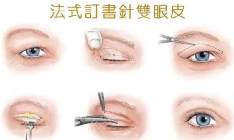 雙眼皮
