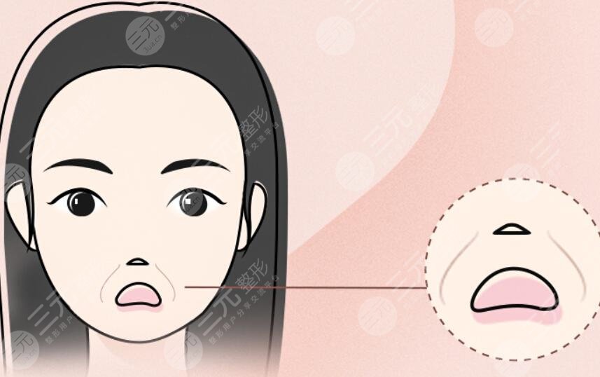 鼻唇溝