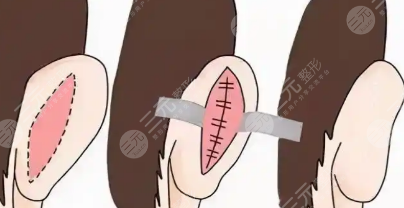 招風(fēng)耳