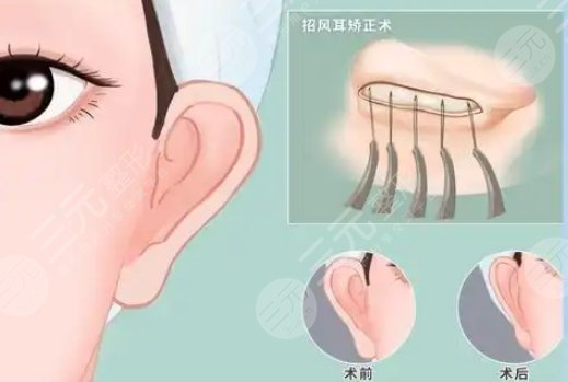 招風(fēng)耳