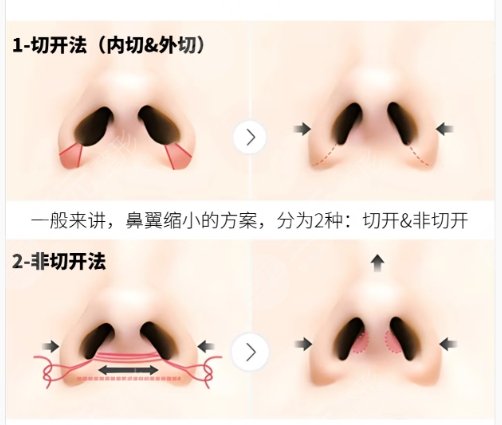 隆鼻