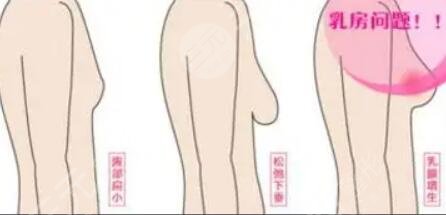 乳房懸吊