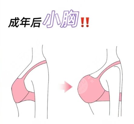 隆胸