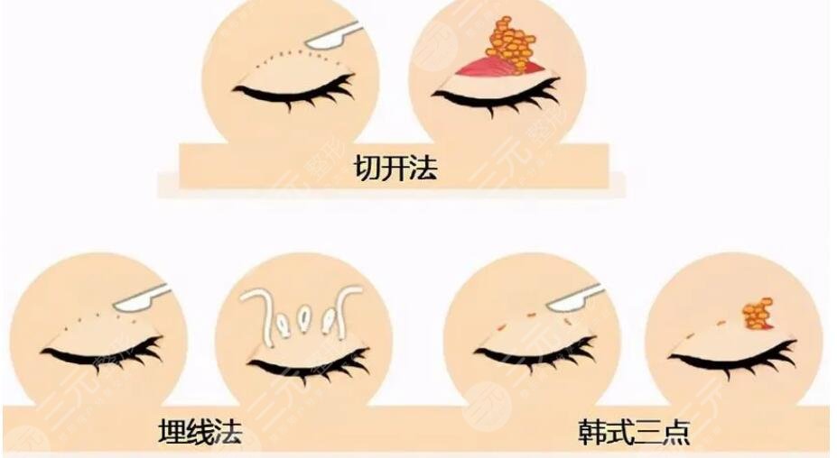 雙眼皮