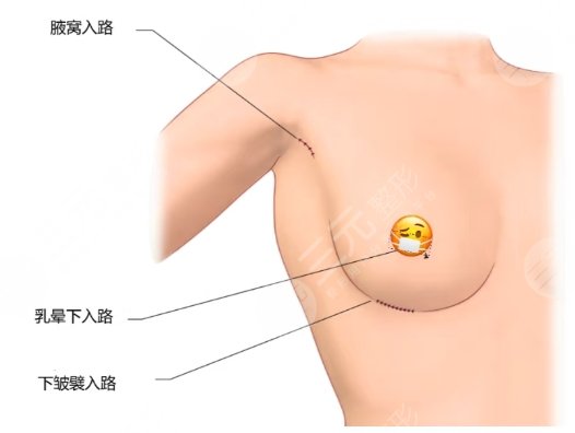 隆胸