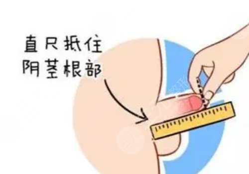 2025長春哪里延長術(shù)做得好