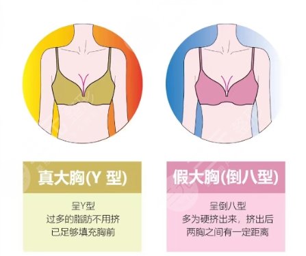 隆胸