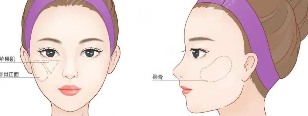 顴骨整形