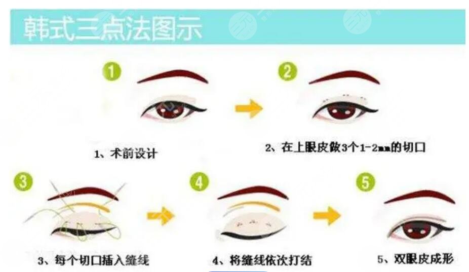 雙眼皮