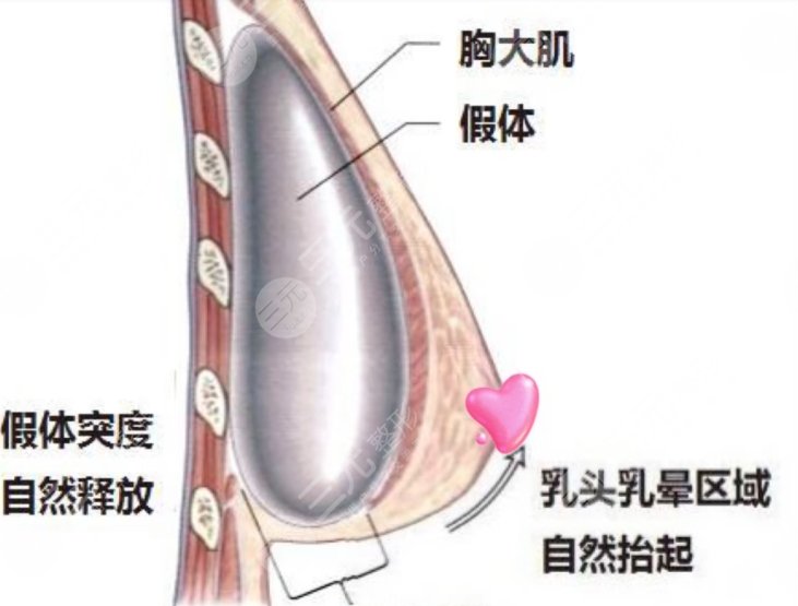 隆胸