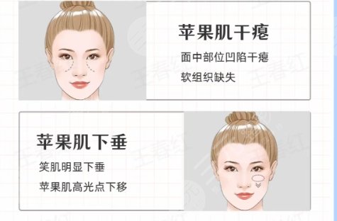 蘋(píng)果肌