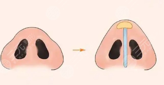 鼻翼整形