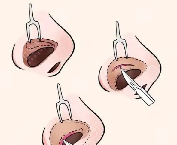 鼻翼整形