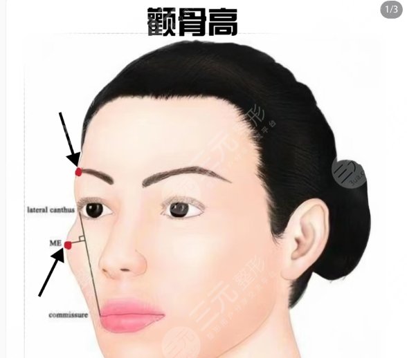 顴骨