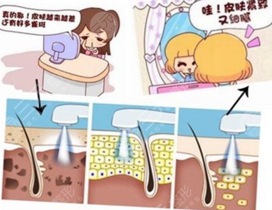 光子嫩膚