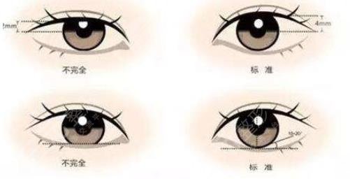 雙眼皮