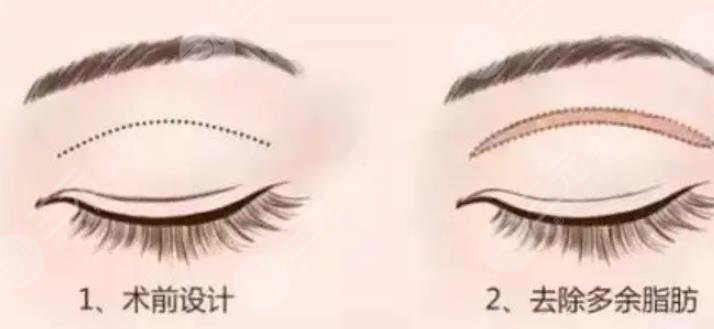 雙眼皮
