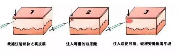 除皺