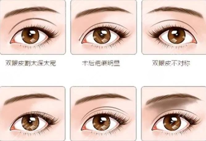 雙眼皮