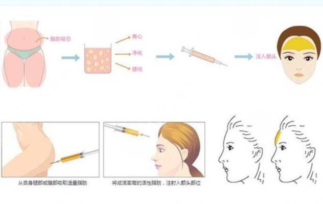脂肪填充