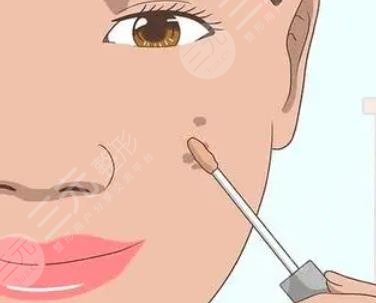 疤痕
