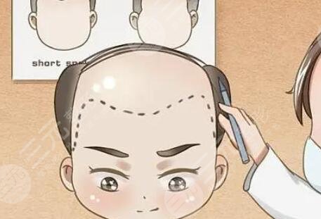 植發(fā)