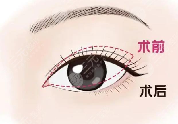 雙眼皮